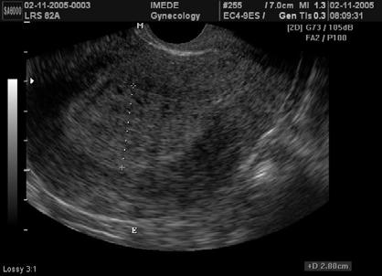 Espessamento endometrial: hiperplasia simples à histologia À histerossonografia a hiperplasia aparece como endométrio difusamente espessado e