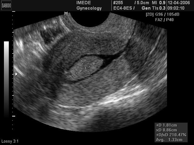 facilmente identificado devido sua aparência ecográfica ecogênica e de formato ovalado contrastando com o endométrio hipoecóico trilaminar.