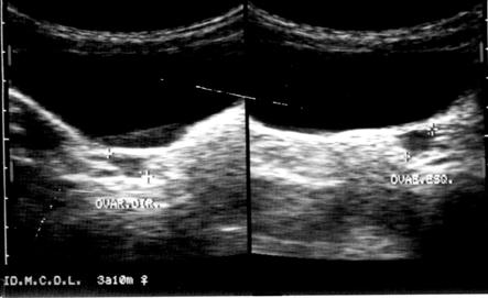 O eco endometrial não é identificado, o canal vaginal é bem fino, e os ovários apresentam-se como estruturas ovóides hipoecóicas, sem folículos identificáveis A puberdade ocorre quando o eixo