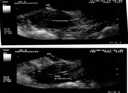 Mioma submucoso Mioma intra-mural com projeção submucosa Sinéquias uterinas: A presença de imagens ecogênicas lineares na cavidade uterina são decorrentes via de regra de sinéquias uterinas ou