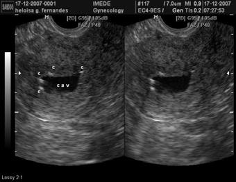 HSNG: endometrite crônica O diagnóstico diferencial das imagens hiperecogênicas lineares com outras alterações mais raras, como metaplasia óssea,