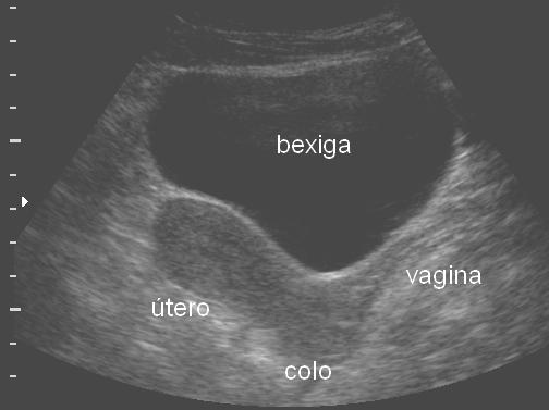 ecográfico dependendo da fase do ciclo, e do uso de hormônios. O canal vaginal é bem definido, com visibilização da luz e paredes vaginais. O volume uterino normal varia de 20 a 90 cc.