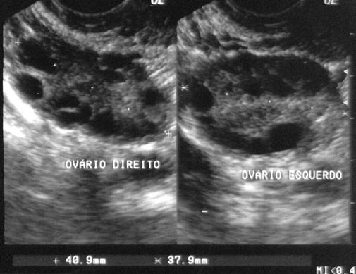 lútea. O aspecto ovariano é típico à ecografia, e o volume depende da fase do ciclo, uso de hormônios, gravidez, etc.