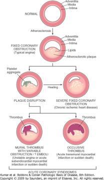 Angina Pectoris 7 Ataques paroxísticos - desconforto torácico precordial ou subesternal Isquemia miocárdio transitória Padrões da angina pectoris: Angina estável (AP típica) Forma mais comum