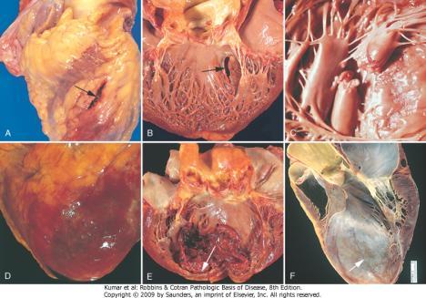 19 20 Cardiopatia Isquêmica Crônica Maioria dos casos - IM previamente (descompensação funcional) Outros casos - doença arterial coronariana obstrutiva grave,