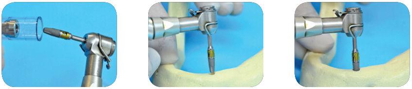 10. Atenção à captura correta do implante e total adaptação do hexágono ao anel de retenção da Chave TD 11. Transporte ao leito cirúrgico.