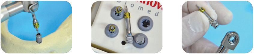 Adaptação CORRETA da Chave TD ao hexágono do implante. A chave TD acoplada ao implante permite a aplicação do torque final.