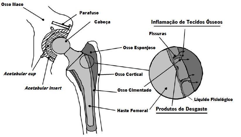 A perda de ligação entre o osso e o implante leva a que o implante tenha de ser substituído por um novo.