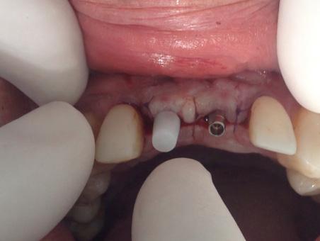 Cilindros adaptados nos pilares cone morse