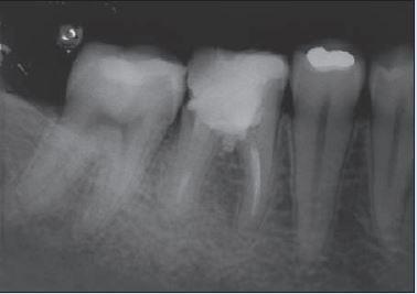 fim o dente foi radiografado (figura 2.1). A paciente encontravase assintomática no exame após dez dias do procedimento.