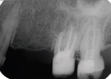 Ainda assim, no segundo caso, o dente após a endodontia e selamento da perfuração, foi pilar de uma prótese fixa extensa e promoveu um resultado satisfatório.