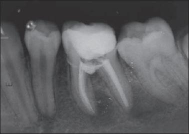 O diagnóstico foi de necrose pulpar, periodontite apical e perfuração de furca causada por cárie.