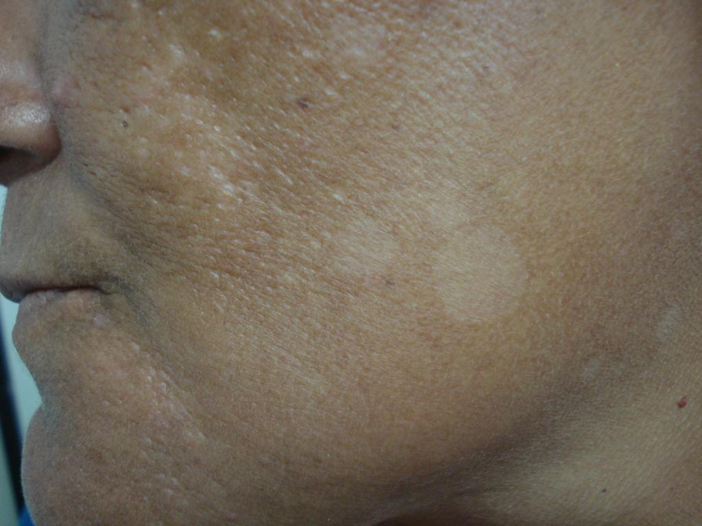 38 Malassezia é considerado parte da microbiota normal da pele (ZAITZ et al. 2000).