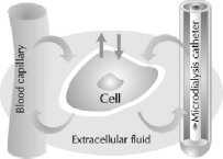 cateteres: Área de penumbra ou isquemia cerebral Área de