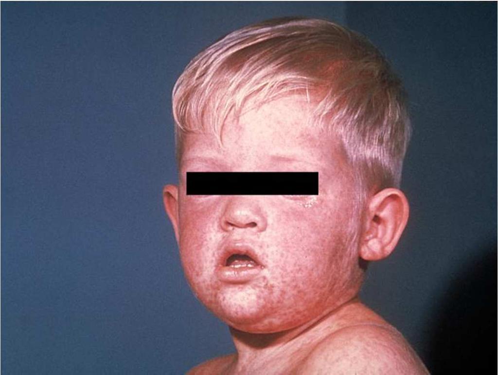 Face de uma criança com sarampo