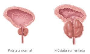 Hiperplasia Prostática 13 C.