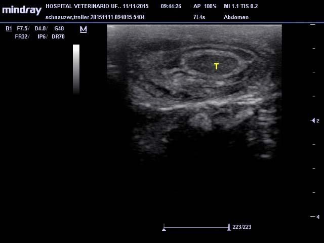 interior do escroto, ginecomastia e presença de secreção leitosa nas mamas. No exame ultrassonográfico evidenciou-se massa heterogênea vascularizada em região mesogástrica direita (8,0 x 6,0 cm) (Fig.