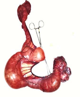 conectada a próstata e ao testículo escrotal (Fig. 4). Foram então realizadas a exérese da massa abominal, orquiectomia e histerectomia. Figura 4.