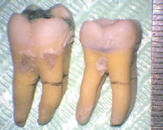 Estudo in vitro da espessura de dentina presente nas raízes mesiais de molares inferiores em relação à zona de risco canais e preservação da integridade da furca.