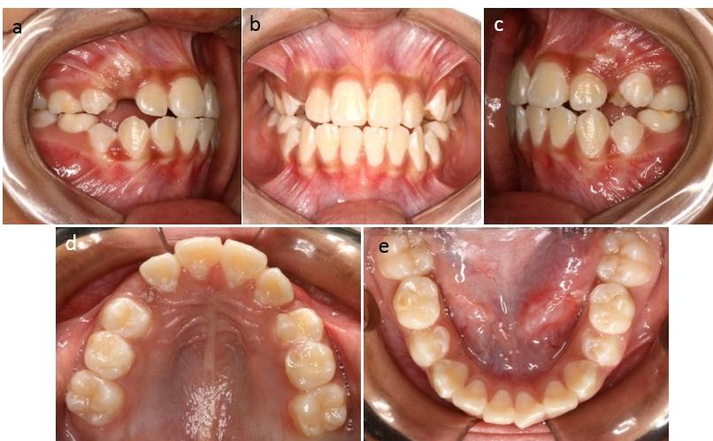 dos dentes permanentes e ausência de espaço para irrupção dos caninos permanentes superiores (Figura 4).