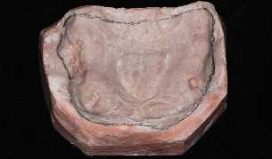Como proposto para o paciente foi feito as exodontias múltiplas dos dentes remanescentes e dos