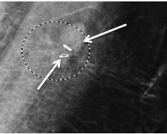 Targeted Axillary Dissection (TAD) 1-5 dias antes da cirurgia Dia da cirurgia