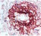 Nas lesões ativas, foram observados infiltrados inflamatórios constituídos por células polimorfonucleares (eosinófilos e neutrófilos) e mononucleares (macrófagos), assim como depósitos perivasculares