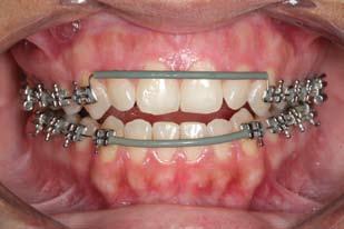 uma possível interposição lingual associada. Quando o paciente não colaborar com o tratamento, deve-se utilizar a grade palatina fixa, ou seja, cimentada aos molares.