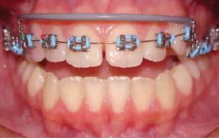 862 Orthodontic Sci. Pract. 2011; 4(16): 859-866 Figura 3 - Esporão lingual fixo.