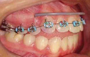 018 aço inoxidável), passando pelos dentes posteriores e com alívio na região anterior (by-pass) e, outro fio resiliente (0.
