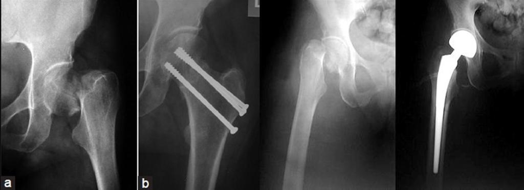 Fratura da extremidade proximal do fémur Muito idosos Complexos Multimorbilidade Síndromes Geriátricos Complicações perioperatórias