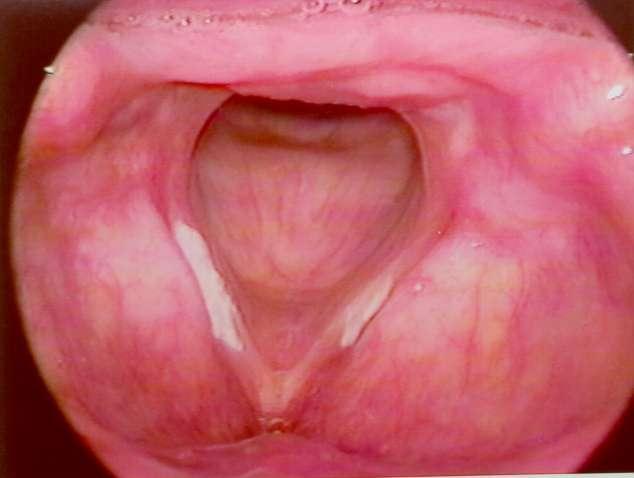 Figura 1 - Imagem de leucoplasia bilateral. Figura 2 - Imagem de leucoplasia bilateral.