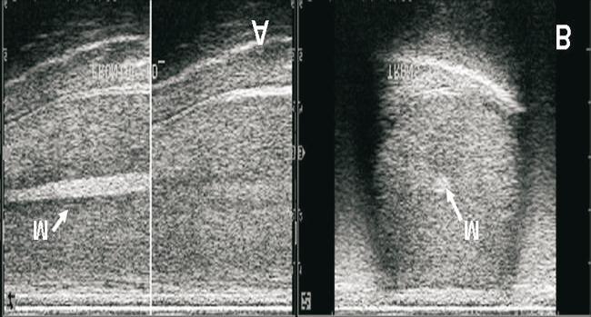 treze (B,E) e quinze (C,F) meses de idade, demonstrando padrão homogêneo e baixa ecogenicidade do parênquima testicular. FIGURA 2.