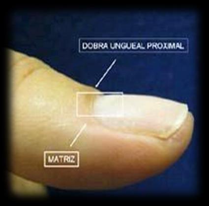 ANATOMIA E ESTRUTURA DA UNHA As unhas são formadas por uma proteína, a queratina, também presente no cabelo e na camada superficialda pele, que confere flexibilidade à unha.