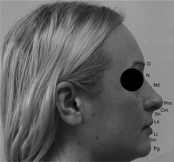 Fig.5 - Pontos cutâneos utilizados na investigação de in Anić-Milosević et al: glabella (G), nasion (N), dorso do nariz