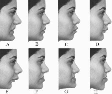 Fig.9 - Distorções do perfil feminino utilizado no estudo