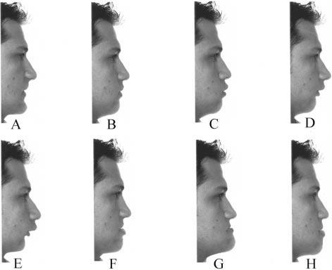 Fig.10 - Distorções do perfil masculino utilizado no