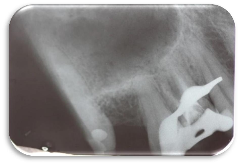 Foi realizado os testes de sensibilidade onde os resultados de percussão e palpação foram positivos e teste térmico ao frio negativo, radiograficamente era observado um ligeiro espessamento