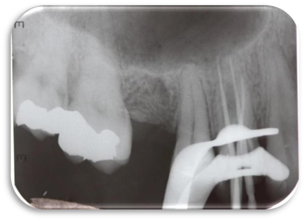 Este procedimento foi realizado nos três canais (FIGURA 6). Uma radiografia final de controle de obturação foi realizada (FIGURA 7). Figura 4. Preparo biomecânico lima reciprocante.