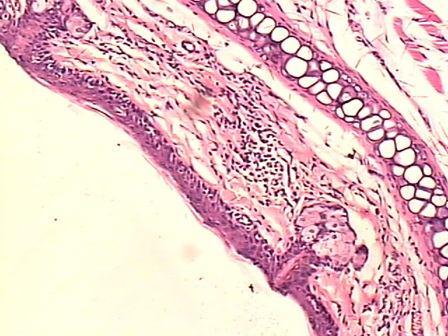 52 Desorganização celular na camada basal devido ao edema intercelular.