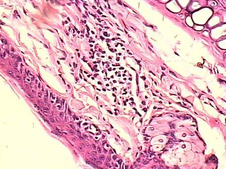 Desorganização celular na camada basal devido ao edema intercelular.