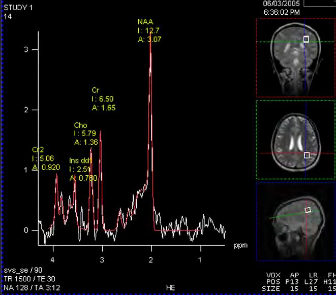 21 Figura 3: Exemplo de obtenção dos diferentes espectros por MRS MRS de paciente com NMO demonstrando boa resolução dos picos metabólitos.