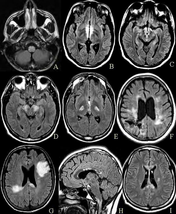 33 Figura 7 Exemplos de alterações encefálicas observadas na RM em pacientes com NMO (Bichuetti, Rivero et al.