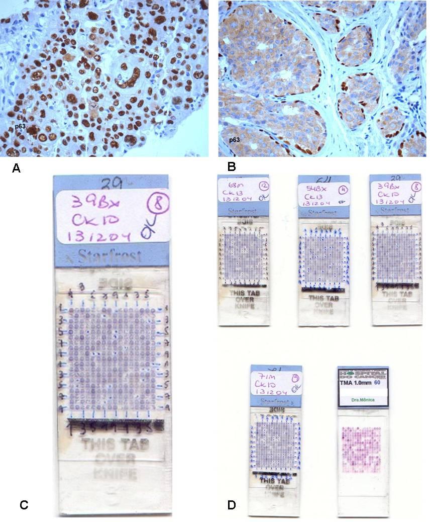 83 A e B: proteína p63 expressão nuclear nas células neoplásicas (A 400x) e em células basais