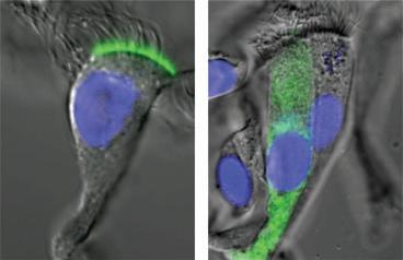 Fibrose cística Grave doença genética: formação de muco alta viscosidade vias aéreas e trato digestivo Causa: mutação no regulador transmembrana de fibrose cística CFTR CFTR é um canal de Cl - A