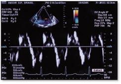 Figura 6: Doppler Tecidual de paciente com 2 anos, 12 kg, apresentando miocardiopatia dilatada com FE = 40%.