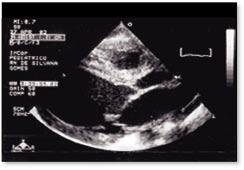 Figura 1. A= Frações de ejeção(32%) e de encurtamento(15%) pelo Modo M de paciente com 1 ano e 2 meses de idade, 9 kg, com miocardiopatia dilatada apresentando dilatação importante de VE (52 mm).