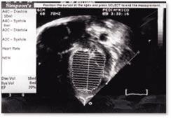 estudado o volume de ejeção que apresentou boa correlação com a angiografia (r = 0,92 a 0,95). Entretanto, a correlação com a fração de ejeção foi baixa (r = 0,68 a 0,82).