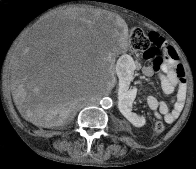 Neoplasia de Testículo