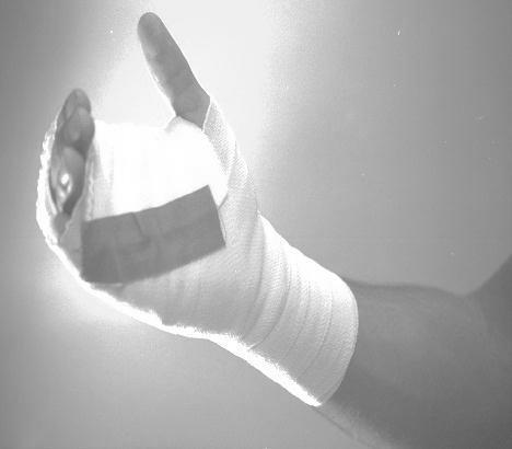 Uma lesão pequena, tratada indevidamente, pode progredir para uma lesão grave.